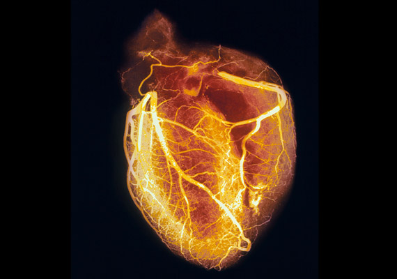 
                        	Az angiogram segítségével éles részletességgel válnak láthatóvá a szív erei. Segítségével időben kiszűrhetőek a szívrohamhoz vezető koszorúér-betegségek.