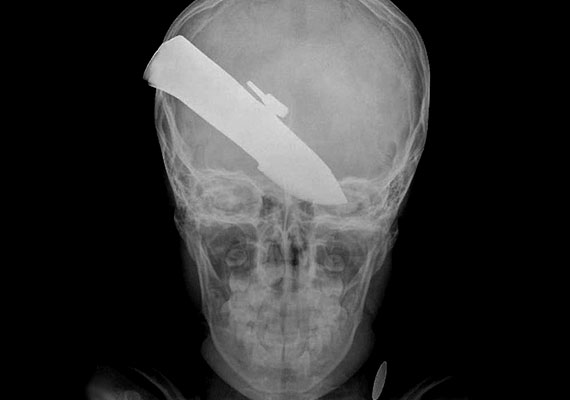	A tízéves kisfiú koponyájáról készült röntgenfelvételen jól látszik egy konyhakés sziluettje. A fiú túlélte az esetet.