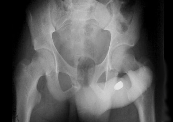 	A képen egy férfi ágyéki röntgenfelvétele látszik, amelyen jól kirajzolódik legérzékenyebb testrészében egy pisztolygolyó.