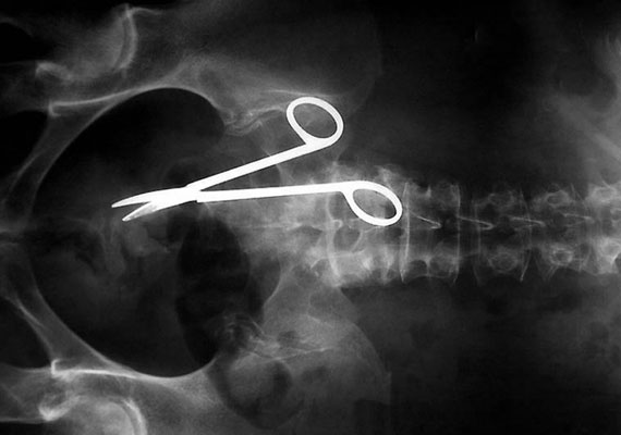 	A röntgenfelvételen látható olló műtét közben maradt a betegben.