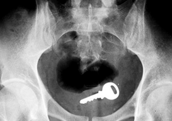	Állítólag a kulcs az egyik leggyakoribb idegen test, amit röntgenfelvételekkel kimutatnak az orvosok. Ezt például a medencében bújt meg.