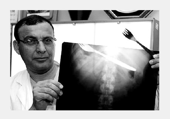 	A képen látható dr. Nikola egy izraeli nő röntgenfelvételét mutatja, aki állítólag véletlenül nyelte le a villát, miközben egy bogár repült a szájába.