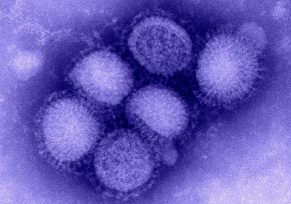 	Az elmúlt években sokat emlegetett H1N1 influenzavírus markánsabb tüneteket produkál, mint a hagyományos A vagy B típusú influenza. Tudj meg többet róla korábbi cikkünkből.