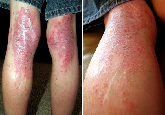 	Az ekcéma nevű bőrgyulladás sok esetben allergiás hajlammal párosul. A betegség lényege, hogy a bőrön viszkető, száraz, pikkelyes foltok jelennek meg, idővel pedig kialakulhatnak folyadékkal teli apró hólyagok, amelyek kifakadnak. A bőr durva tapintásúvá válik. Tudj meg többet a betegségről korábbi cikkünkből!