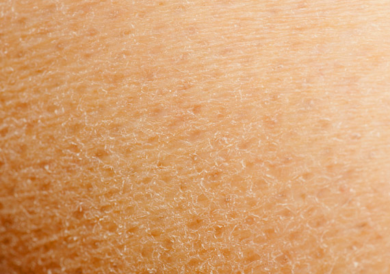 	A száraz bőr elsősorban a kissé pikkelyes felső hámrétegről ismerhető fel. Ha nem jár gyulladással, és csak enyhe viszketést tapasztal a gyerek, valószínűleg elég lesz kicsiknek szánt testápolóval, illetve babaolajjal kenned a bőrét.