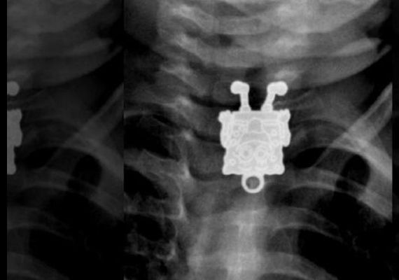 
                        	A röntgent látván az orvosok ledöbbentek, mivel Spongyabob kockanadrág mosolygott rájuk a felvételről. Forrásunk nem írta le, mi történt a továbbiakban, de remélhetőleg hamar jobban lett a kicsi.