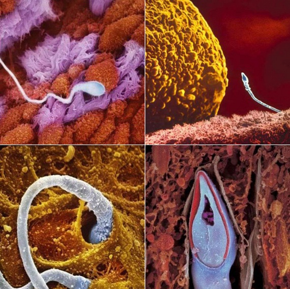 A bal felső képen egy, a petevezetékbe került hímivarsejtet láthatsz. Jobbra fent, a petesejt közvetlen szomszédságában látható a hímivarsejt, amely a bal alsó képen látható módon fúrja át magát a petesejt falán. Itt még akadnak versenytársai: közülük a leggyorsabb és legügyesebb győz. A jobb alsó felvételen a már bejutott hímivarsejtet láthatod.