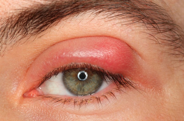 A száraz szem kezelése házilag.
