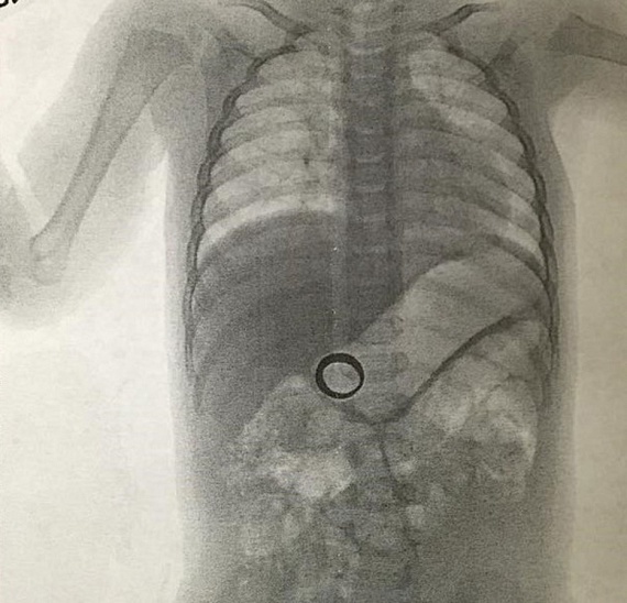 	Nem találták az anyuka házassági gyűrűjét: később 14 hónapos kisfiuk hasában mutatta ki a röntgen.
