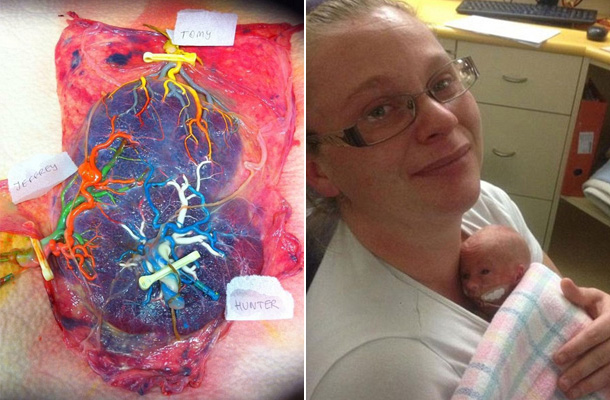 Balra a színezett placenta, jobbra az anya és a kis Tomy