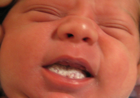 szájpenész kezelése babáknál
