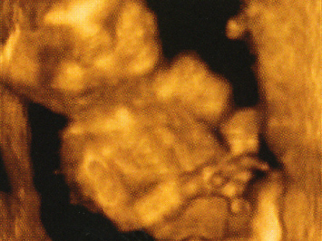 A baba egyre mozgékonyabb, testét magzatszőr borítja (Fotó: Pocakosnapló)