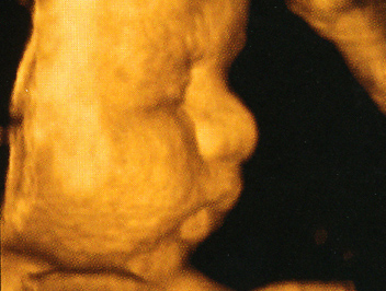 A baba testét egyre vastagabban borítja a magzatmáz (Fotó: Pocakosnapló)