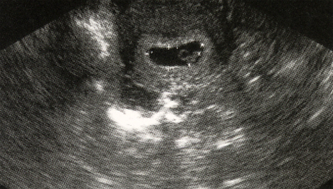 Már az ultrahang felvételen is megjelenik az embrió (Fotó: Pocakosnapló)