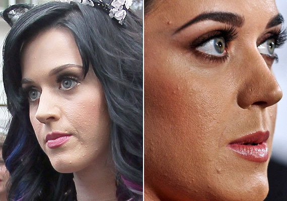	Katy Perry aknéi jó pénzt hoztak a konyhára az énekesnőnek, ő volt a Proactiv pattanás elleni kozmetikai program egyik arca. Valószínűleg hatásos volt a program, mert az énekesnő bőre ma már nagyon szép.