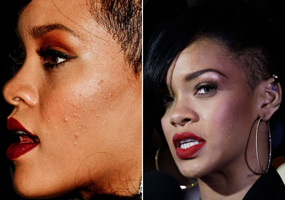 	Rihanna szintén nem visszafogottságáról híres, bőrének nem tesz jót a pörgős, bulizós életmód.
