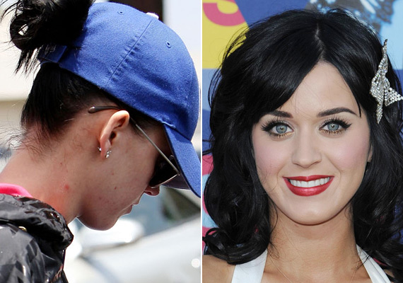 	Katy Perry már egy akné elleni kozmetikum arca, ami állítólag bevált neki, de valószínűleg ő is lézeres kezeléssel szabadult meg a bosszantó fertőzéstől.